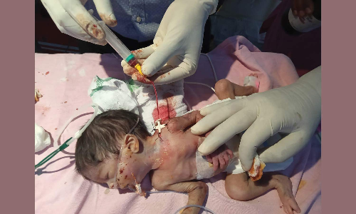 திருவண்ணாமலை அரசு மருத்துவமனையில் எடை குறைவாக பிறந்த பெண் குழந்தைக்கு நவீன சிகிச்சை