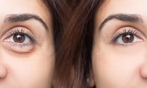 கண்களுக்குக் கீழ் வீக்கம்... சரிசெய்யும் வீட்டு வைத்தியம்