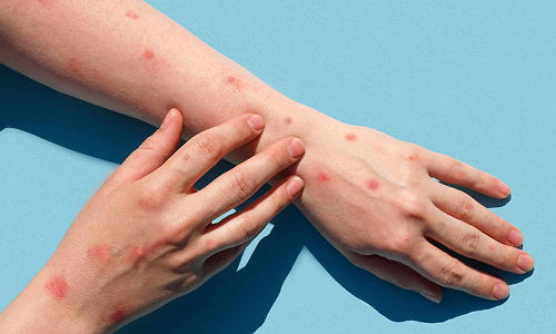 குரங்கு அம்மை தொற்றும்... தடுப்பு நடவடிக்கைகளும்