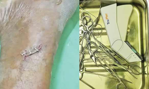 கையில் காயத்துடன் வந்த தொழிலாளிக்கு சரிஜிகல் ஸ்டேப்ளர் மூலம் தையல்