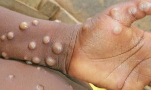 1950-ம் ஆண்டு குரங்கு அம்மை நோய் முதன் முதலில் ஆப்பிரிக்க நாட்டில் உருவானது