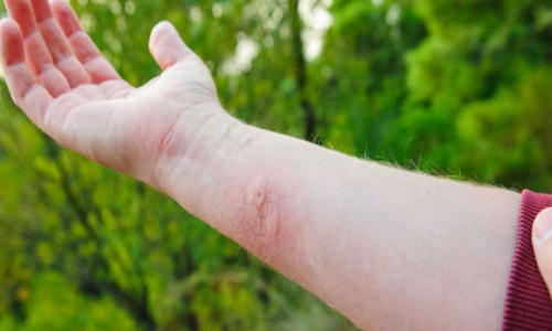 புதர்களை அகற்றிய பள்ளி குழந்தைகளுக்கு பூச்சிக்கடி அலர்ஜி