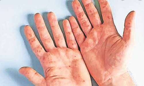 தக்காளி காய்ச்சல் பரவல்- மாநிலங்களுக்கு மத்திய அரசு அறிவுரை