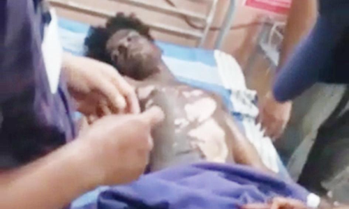 மின்சாரம் தாக்கி தீக்காயம் அடைந்த வாலிபருக்கு தொடர்ந்து சிகிச்சை