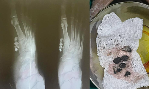 விபத்தில் காயம் அடைந்தவரின் கால் விரலுக்குள் இருந்த ஜல்லி கற்களை அகற்றாமல் தையல் போட்ட டாக்டர்கள்