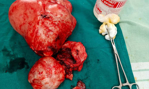 பெண்ணின் வயிற்றில் இருந்த 4½ கிலோ கட்டி அகற்றம்