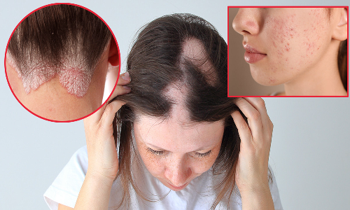 முகப்பரு, பருத்தழும்பு, வழுக்கை, சொரியாசிஸ், படர்தாமரைக்கு நவீன மருத்துவத்தால் தீர்வு