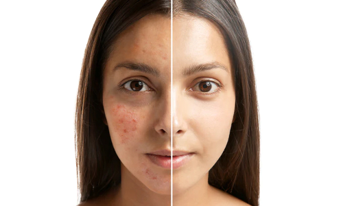 முகப்பருக்களுக்கு முற்றுப்புள்ளி