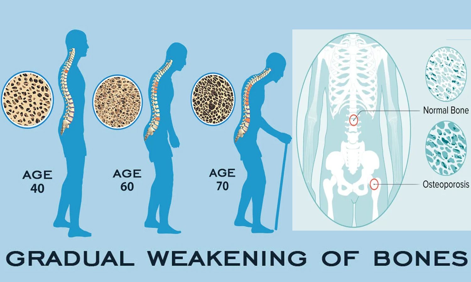 40 வயதானவர்களை அதிகம் தாக்குகிறது: எலும்பு புரை நோயை கட்டுப்படுத்தும் வழிமுறைகள் 40 வயதானவர்களை அதிகம் தாக்குகிறது: எலும்பு புரை நோயை கட்டுப்படுத்தும் வழிமுறைகள்