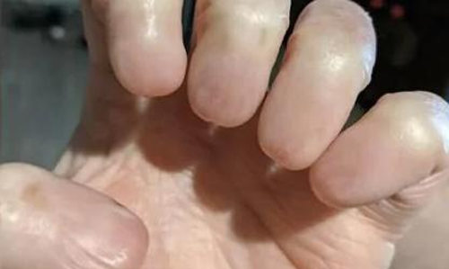கைவிரல்களில் நகங்கள் இல்லாமல் இணையத்தில் வைரலாகும் புகைப்படம்