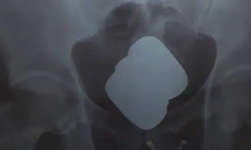 ரூ.42 லட்சம் தங்கத்தை குடலில் மறைத்து கடத்தி வந்த பயணி கைது