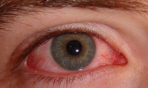 மெட்ராஸ்-ஐ பாதிப்பில் இருந்து கண்களை பாதுகாப்பது எப்படி?