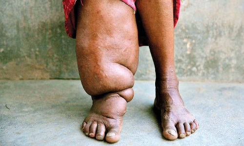 காங்கயத்தில்  யானைக்கால் நோய் கண்டறியும்  பரிசோதனை முகாம்