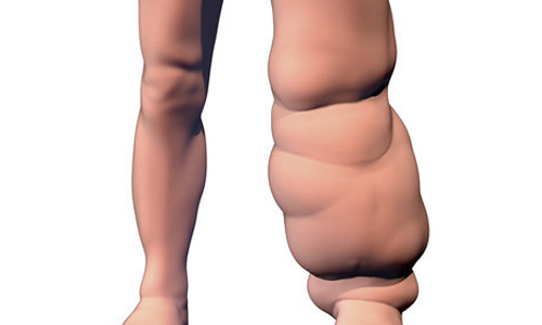 வெள்ளகோவிலில் யானைக்கால் நோய் கண்டறியும் முகாம்