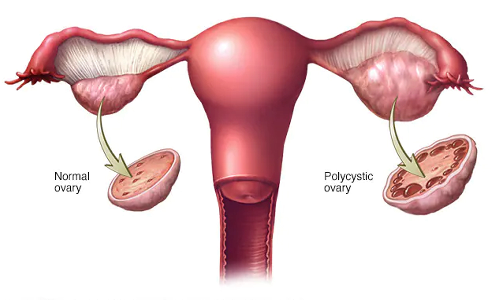 பெண்களை தாக்கும் பி.சி.ஓ.எஸ்... ஆரம்ப கட்ட அறிகுறிகள் என்ன?