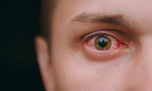 சென்னை புறநகர் பகுதிகளில் மெட்ராஸ் ஐ கண்நோய் வேகமாக பரவுகிறது