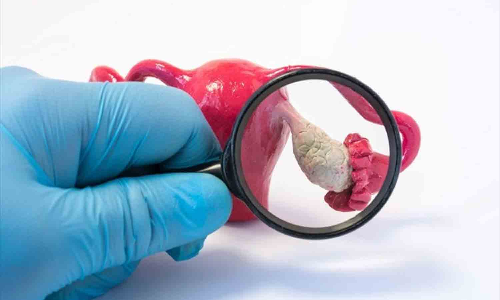 பி.சி.ஓ.டி. பற்றிய கட்டுக்கதைகளும், உண்மைகளும்...