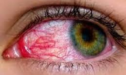 அரியலூரில் வேகமாக பரவும் மெட்ராஸ் ஐ