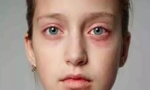 மெட்ராஸ் ஐ பாதிப்பை தடுக்கும் வழிகள் -டாக்டர்கள் விளக்கம்