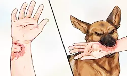 கொளத்தூர் அருகே  வெறி நாய் கடித்து பள்ளி மாணவர்கள் காயம்