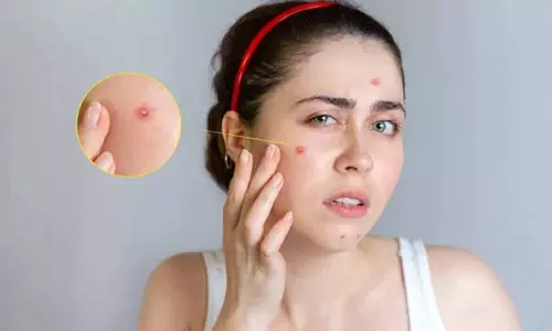 எண்ணெய் பசை சருமமும்... முகப்பரு பிரச்சனையும்.... தீர்வு என்ன?