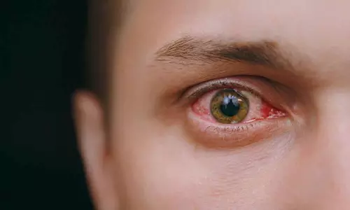 மெட்ராஸ்- ஐ நோய் பரவலை கட்டுப்படுத்த என்னென்ன செய்ய வேண்டும்?