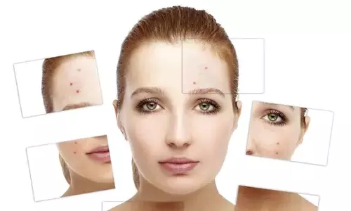 முகப்பருக்களைத் தடுக்க... தவிர்க்க..