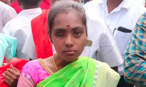 தவறான சிகிச்சையால் பெண்ணின் கண் அகற்றம்- அரசு ஆஸ்பத்திரியில் உறவினர்கள் தர்ணா போராட்டம்