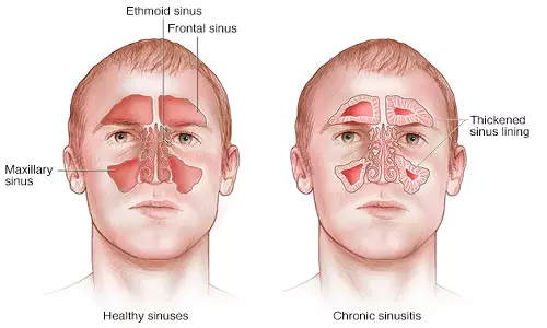 சைனசைடிஸ் நோய்க்கு சித்த மருத்துவத்தில் சிறந்த சிகிச்சை