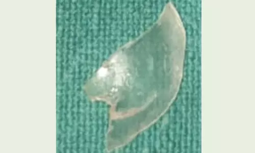 7 மாத குழந்தையின் மூச்சுக்குழாயில் சிக்கிய பிளாஸ்டிக் பொருள் அகற்றம்- டாக்டர்கள் சாதனை