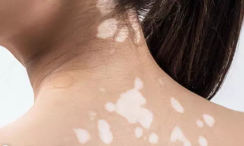 உடலில் வெண்புள்ளிகள்... சித்த மருத்துவத் தீர்வுகள்