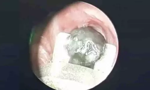 1 ½  வயது குழந்தையின் மூச்சு குழாயில் சிக்கிய குறுமிளகு - அரசு டாக்டர்கள் நவீன சிகிச்சை மூலம் அகற்றினர்