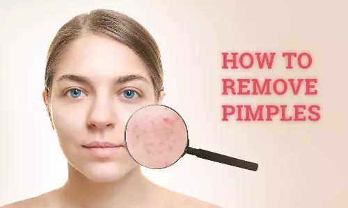 இந்த வாழ்க்கை முறையை பின்பற்றினால் முகப்பரு வராமல் தவிர்க்கலாம்....