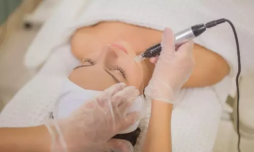 பெண்களின் முகம், சருமத்தில் தேவையற்ற முடிகளின் வளர்ச்சியா?