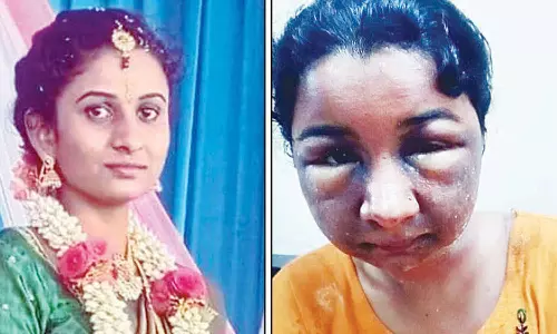 மேக்கப்பால் மணப்பெண்ணின் முகம் பாதிப்பு; திருமணத்தை நிறுத்திய மணமகன்