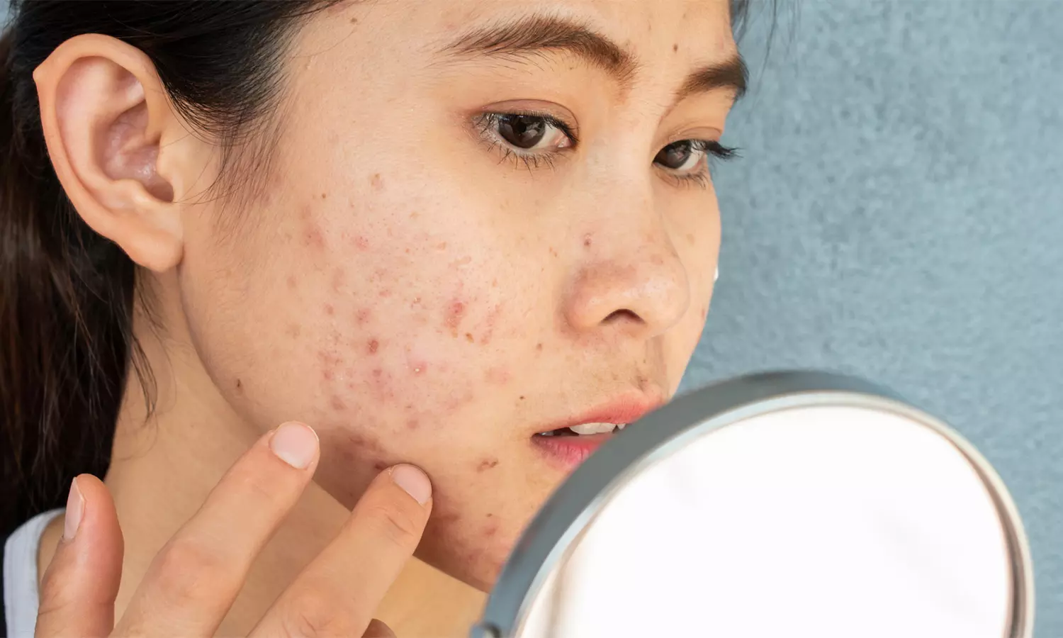 முகப்பருவை வராமல் தடுக்கும், வந்தால் கட்டுப்படுத்தும் வழிமுறைகள்... | Ways to prevent and control Pimples