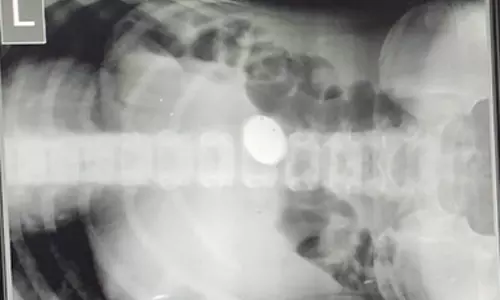 பொன்னேரியில் 10 ரூபாய் நாணயத்தை விழுங்கிய பள்ளி மாணவன்