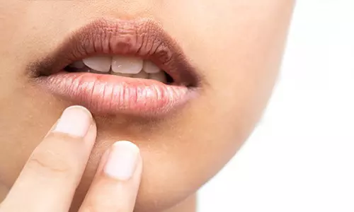 உதடு பிக்மென்டேஷன் பிரச்சனைக்கு தீர்வு