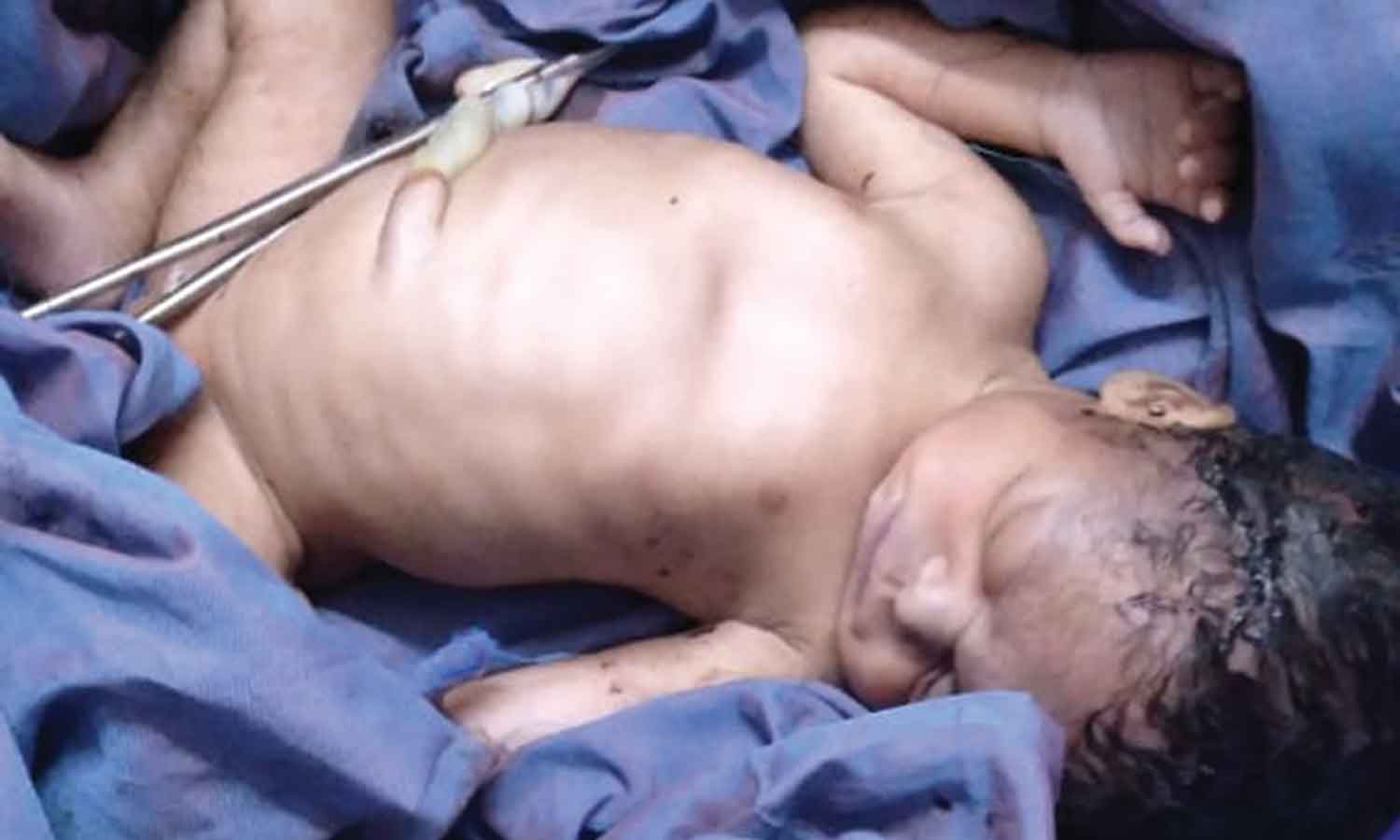 திருமணமாகாமல் கர்ப்ப்பிணியான சிறுமி பலி- கர்ப்பத்திற்கு காரணமான வாலிபர்  மீது போக்சோ சட்டம் பாய்கிறது