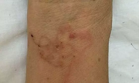 பச்சை ரத்தத்துடன் உணவு சமைத்து சாப்பிட்ட பெண்ணின் மூளைக்குள் புகுந்த ஒட்டுண்ணி புழுக்கள்