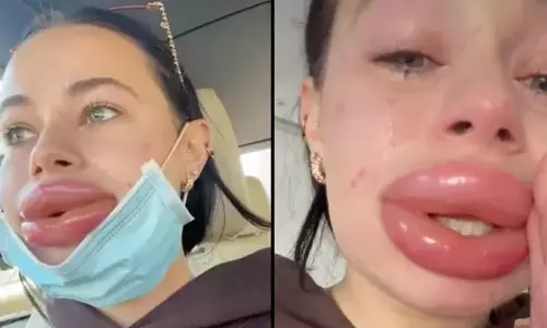 இலவசத்தை நம்பியதால் வீங்கிய உதடு-  அமெரிக்க மாடல் அழகியின் அறிவுரை