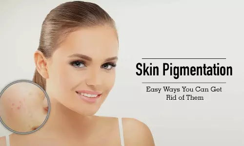 முக அழகைப் பாதிக்கும் பிக்மென்டேஷன் ஏற்பட காரணம் என்ன?