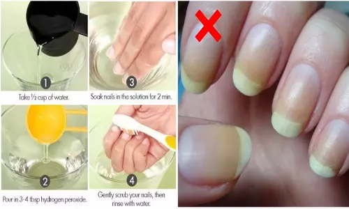 நகங்கள் மஞ்சள் நிறமாக மாறினால் எவ்வாறு சுத்தம் செய்வது?