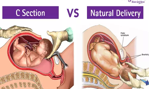 சிசேரியன் பிரசவத்திற்கான காரணமும்... சுகப்பிரசவத்தின் நன்மைகளும்...