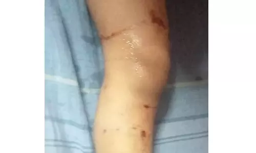 நாய்கள் கடித்து சிறுமி படுகாயம்