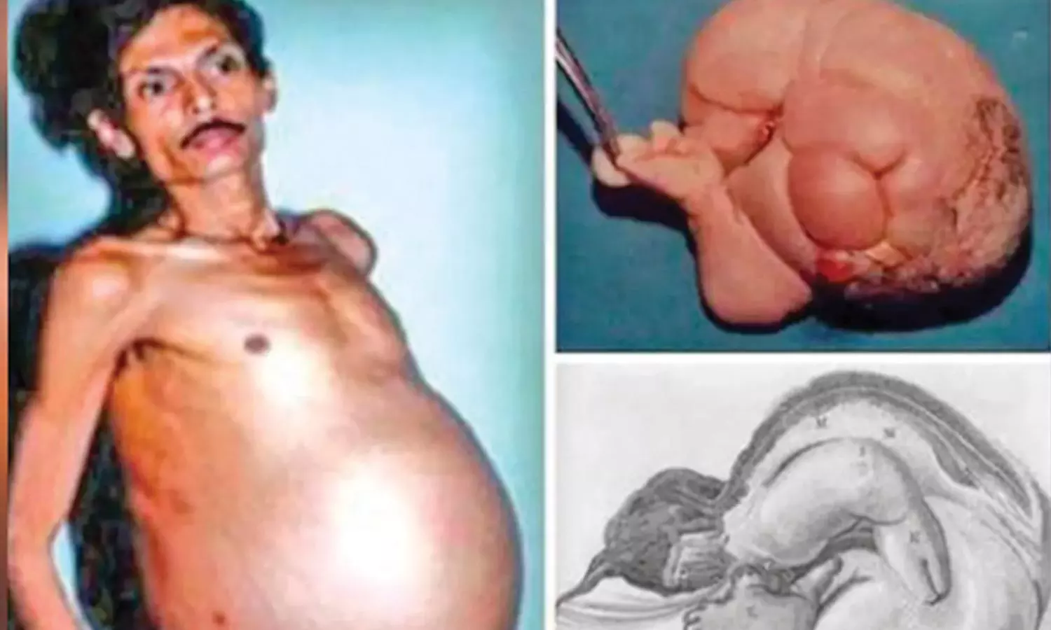 36 ஆண்டுகளாக வயிற்றில் இரட்டை குழந்தைகளை சுமந்த முதியவர்- அறுவை சிகிச்சை மூலம் அகற்றம் 36 ஆண்டுகளாக வயிற்றில் இரட்டை குழந்தைகளை சுமந்த முதியவர்- அறுவை சிகிச்சை மூலம் அகற்றம்