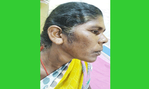 பெண்ணுக்கு தைராய்டு சுரப்பி அகற்றம்