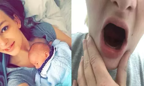 அரிய வகை நோய்: கர்ப்பகாலத்தில் கடுமையான வாந்தியால் அனைத்து பற்களையும் இழந்த பெண்