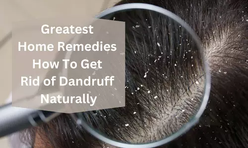 பொடுகுத் தொல்லையா? சமையல் அறையில் இருக்கும் பொருள்களே தீர்வு தரும்...