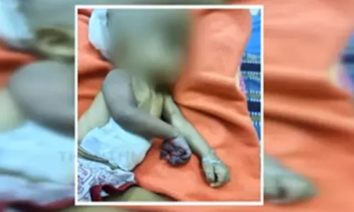 கை அழுகிய விவகாரம்- குழந்தைக்கு அறுவை சிகிச்சை செய்து கையை அகற்றிய மருத்துவர்கள்